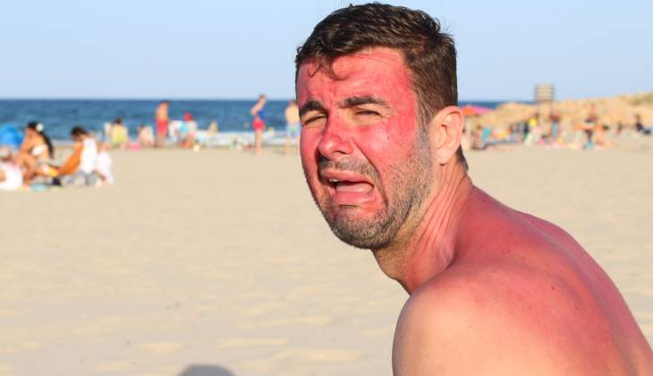 A man on a beach looking sad because he is sunburnt.